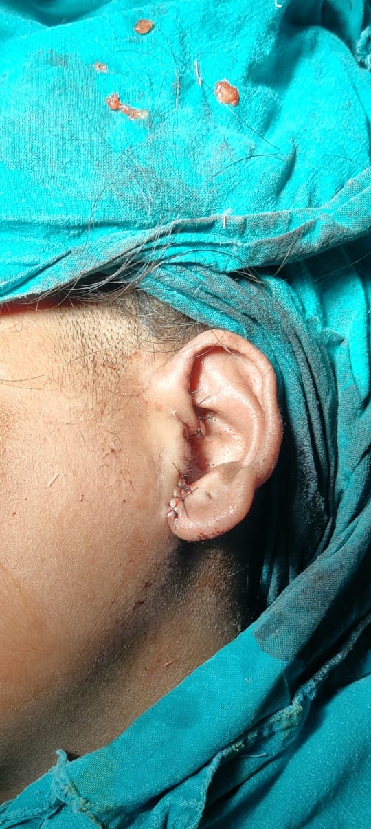 After TMJ Ankylosis Surgery