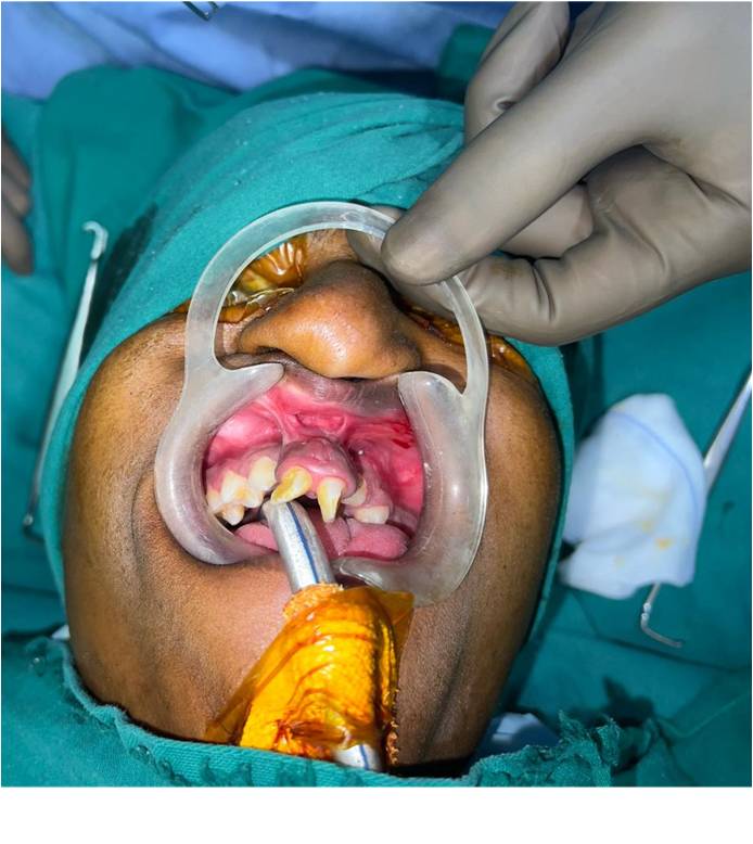 Before Secondary Alveolar Bone Grafting
