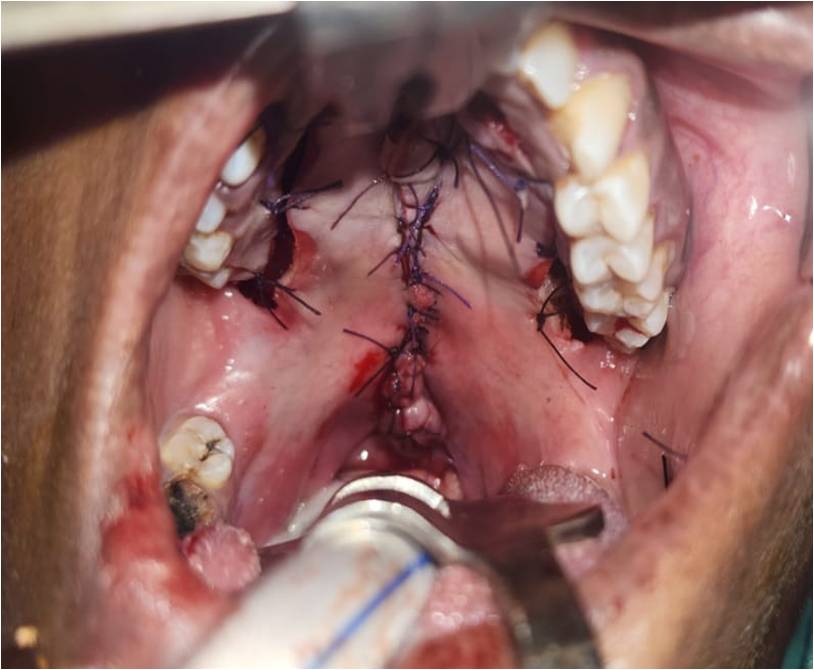 After Veau II Soft And Hard Palate Cleft
