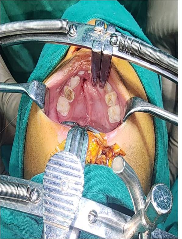 Before Type IV Palatal Fistulae