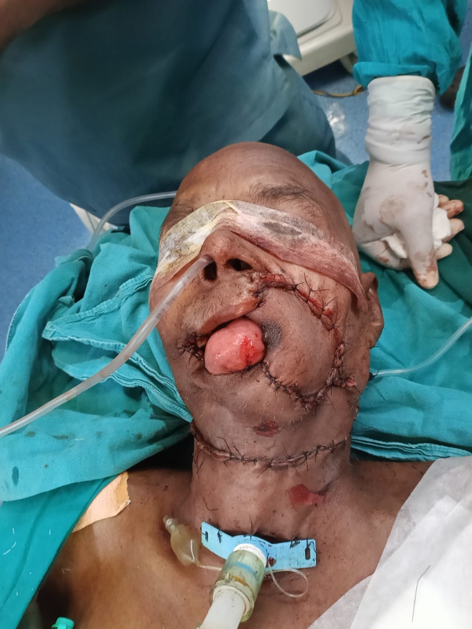 After Oral Cancer And Reconstructive Surgery