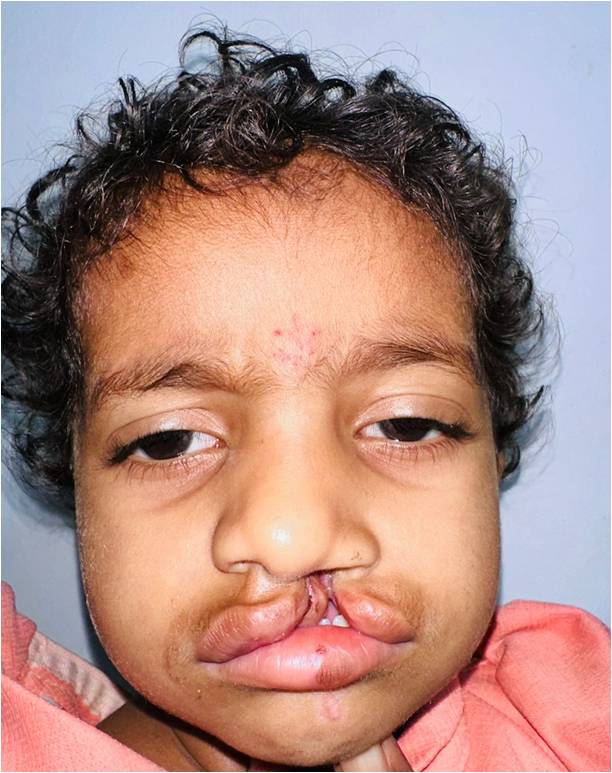 Before Unilateral Cleft Lip