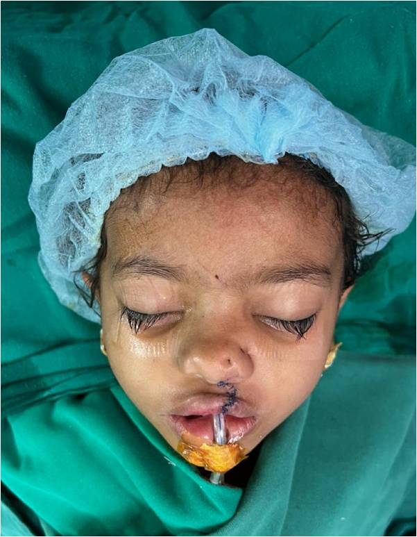 After Unilateral Cleft Lip