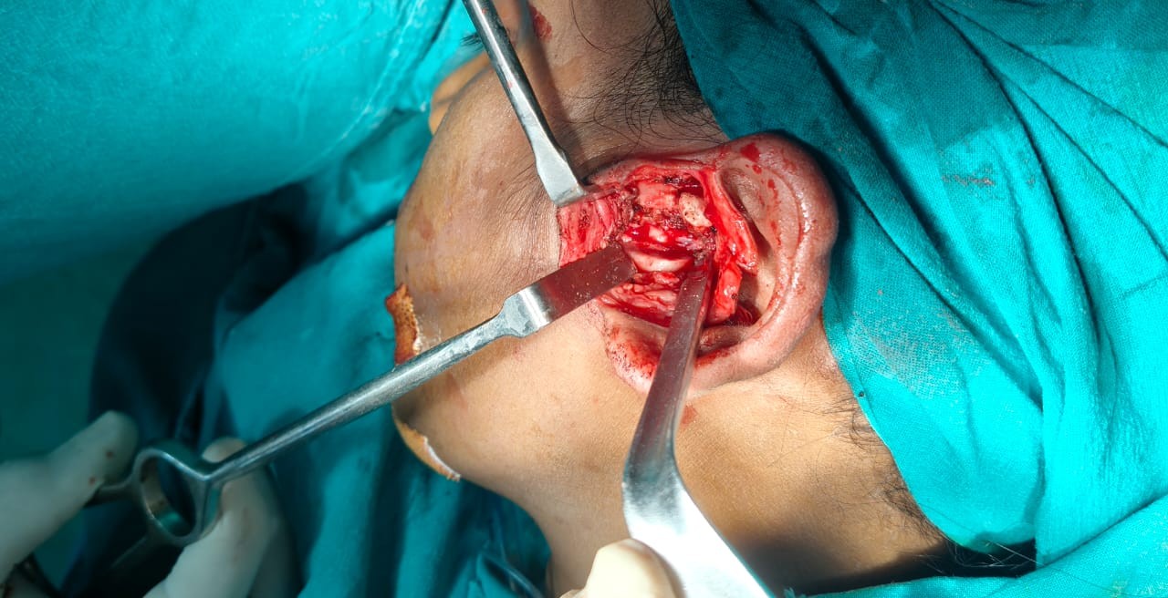 Before TMJ Ankylosis Surgery